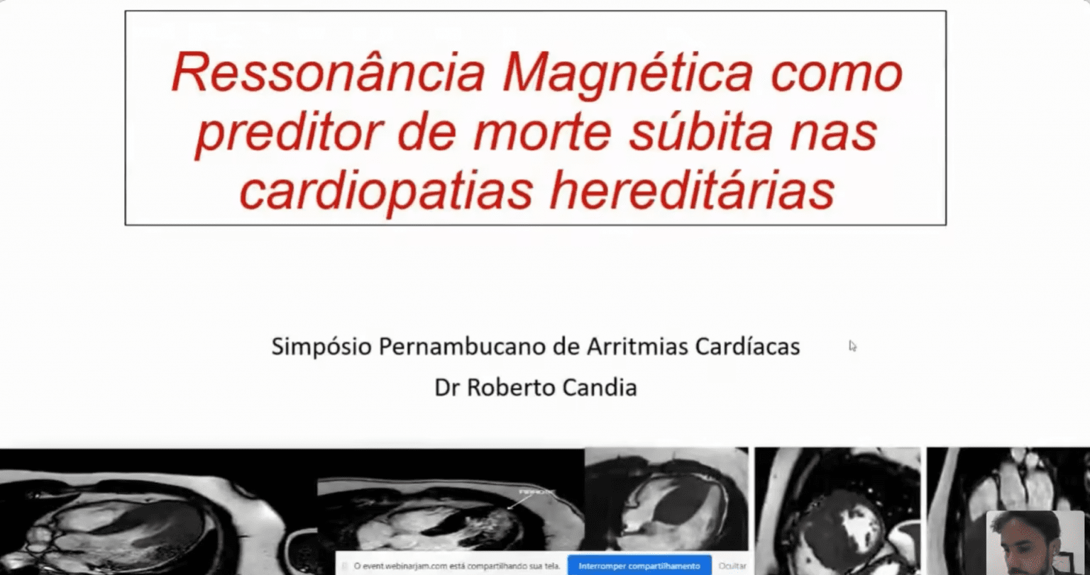 [Sbc Pe] Corte - Ressonância Magnética Como Preditor De Morte Súbita Nas Cardiopatias Hereditárias - 28/11/2020