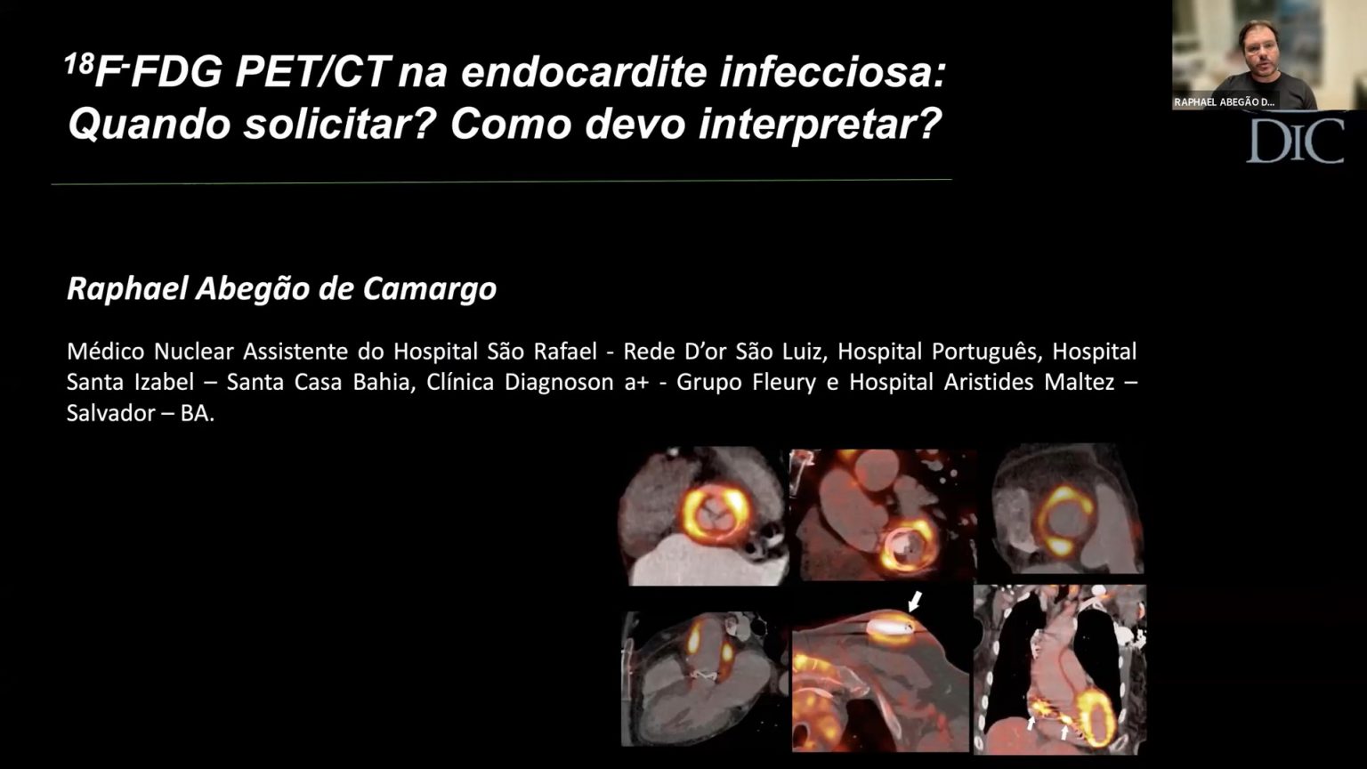 Pet Ct Na Endocardite Infecciosa - Raphael Abegao De Camargo