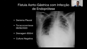Fístula Aorto-Gástrica Com Infecção De Endoprótese